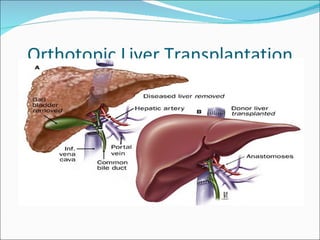 Orthotopic Liver Transplantation The most definitive form of therapy for complications of portal hypertension Selective patients: Coast Unavailability  Immunosuppresion 