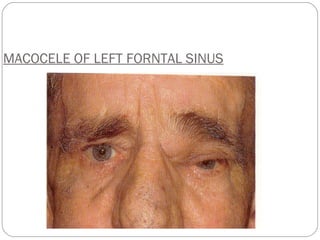 MACOCELE OF LEFT FORNTAL SINUS 
