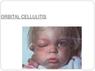 ORBITAL CELLULITIS 
