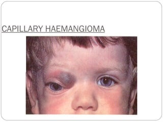 CAPILLARY HAEMANGIOMA 