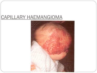 CAPILLARY HAEMANGIOMA 