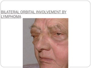 BILATERAL ORBITAL INVOLVEMENT BY LYMPHOMA 