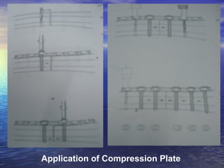 Application of Compression Plate
 