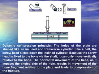 Dynamic compression principle: The holes of the plate are
shaped like an inclined and transverse cylinder. Like a ball, the
screw head slides down the inclined cylinder. Because the screw
head is fixed to the bone via the shaft, it can only move vertically
relative to the bone. The horizontal movement of the head, as it
impacts the angled side of the hole, results in movement of the
bone fragment relative to the plate and leads to compression of
the fracture.
 