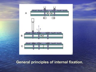 General principles of internal fixation.
 