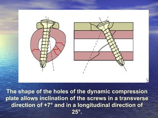 The shape of the holes of the dynamic compression
plate allows inclination of the screws in a transverse
  direction of +7° and in a longitudinal direction of
                          25°.
 