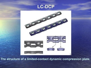 LC-DCP




The structure of a limited-contact dynamic compression plate.
 