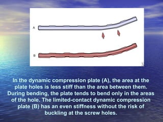 In the dynamic compression plate (A), the area at the
  plate holes is less stiff than the area between them.
During bending, the plate tends to bend only in the areas
 of the hole. The limited-contact dynamic compression
    plate (B) has an even stiffness without the risk of
               buckling at the screw holes.
 