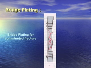 Bridge Plating :




 Bridge Plating for
comminuted fracture
 