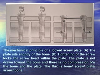 The mechanical principle of a locked screw plate. (A) The
plate sits slightly of the bone. (B) Tightening of the screw
locks the screw head within the plate. The plate is not
drawn toward the bone and there is no compression b/w
the bone and the plate. The flux is bone/ screw/ plate/
screw/ bone.
 
