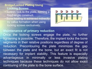 Bridge/Locked Plating Using
   Locking Screws
 • Screws lock to the plate, forming a
   fixed-angle construct.
 • Bone healing is achieved indirectly
   by callus formation when using
   locking screws exclusively.

Maintenance of primary reduction
Once the locking screws engage the plate, no further
tightening is possible. Therefore, the implant locks the bone
segments in their relative positions regardless of degree of
reduction. Precontouring the plate minimizes the gap
between the plate and the bone, but an exact fit is not
necessary for implant stability. This feature is especially
advantageous in minimally or less invasive plating
techniques because these techniques do not allow exact
contouring of the plate to the bone surface.
 