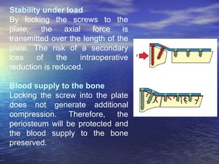 Stability under load
By locking the screws to the
plate,   the    axial    force    is
transmitted over the length of the
plate. The risk of a secondary
loss    of    the    intraoperative
reduction is reduced.

Blood supply to the bone
Locking the screw into the plate
does not generate additional
compression.     Therefore,   the
periosteum will be protected and
the blood supply to the bone
preserved.
 