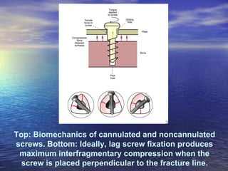 Top: Biomechanics of cannulated and noncannulated
screws. Bottom: Ideally, lag screw fixation produces
 maximum interfragmentary compression when the
  screw is placed perpendicular to the fracture line.
 