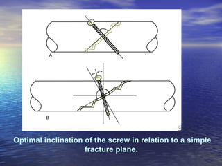 Optimal inclination of the screw in relation to a simple
                    fracture plane.
 