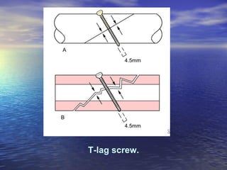 T-lag screw.
 