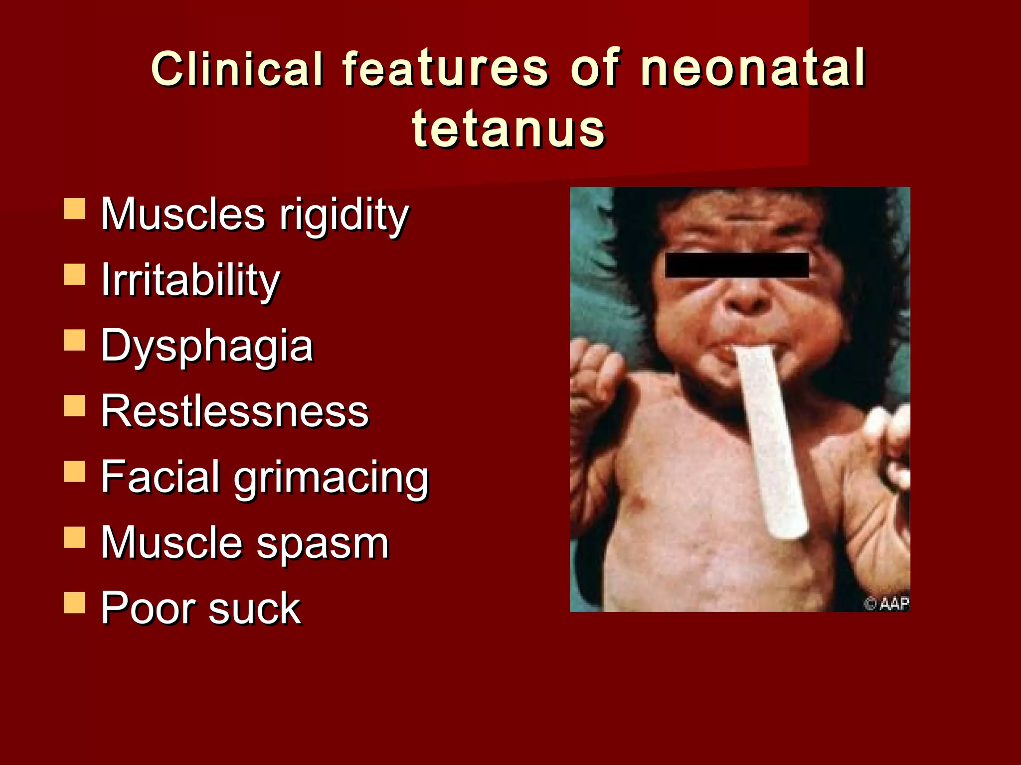 Clinical feaClinical fea tures of neonataltures of neonatal
tetanustetanus
 Muscles rigidityMuscles rigidity
 IrritabilityIrritability
 DysphagiaDysphagia
 RestlessnessRestlessness
 Facial grimacingFacial grimacing
 Muscle spasmMuscle spasm
 Poor suckPoor suck
 
