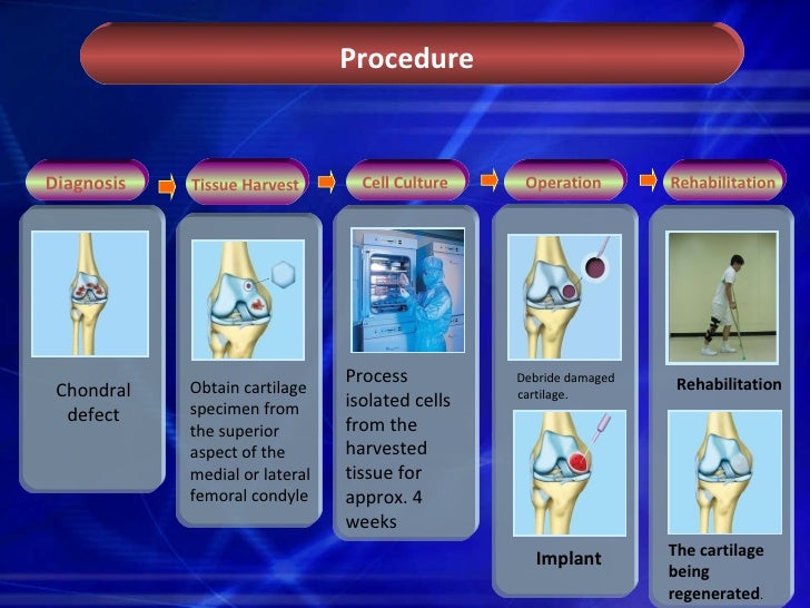 Knee Cartilage surgery in India