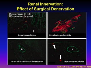 Renal Innervation:
        Effect of Surgical Denervation
Efferent nerves (in red)
Afferent nerves (in green)




          Renal parenchyma             Renal artery adventitia




 2 days after unilateral denervation                   Non-denervated side

                                               Veelken R et al. JASN 2008;19:1371-1378
 