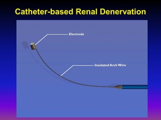Catheter-based Renal Denervation
 