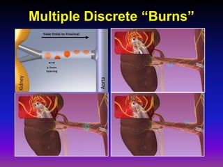 Multiple Discrete “Burns”
 