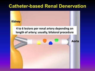 Catheter-based Renal Denervation


 Kidney

   4 to 6 lesions per renal artery depending on
   length of artery; usually, bilateral procedure

                                               Aorta
 