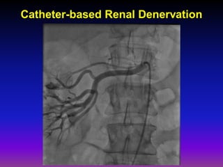 Catheter-based Renal Denervation
 