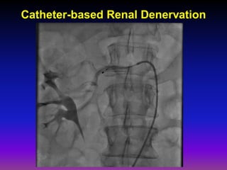 Catheter-based Renal Denervation
 