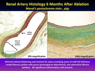 Renal Artery Histology 6 Months After Ablation
                     Movat’s pentachrome stain , pigs




                      cutting
                      artifact



          Zone of
          energy
          delivery




                       20X magnification                                100X magnification

Minimal intimal thickening and minimal IEL injury overlying areas of mild full thickness
medial fibrosis (yellow with green [proteoglycan deposition]), and adventitial fibrosis
                  (yellow). No significant inflammatory cells present.
 