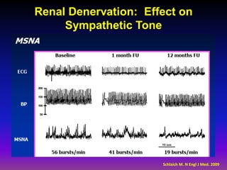 Renal Denervation: Effect on
     Sympathetic Tone




                      Schlaich M. N Engl J Med. 2009
 