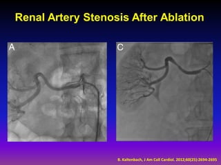 Renal Artery Stenosis After Ablation




                   B. Kaltenbach, J Am Coll Cardiol. 2012;60(25):2694-2695
 
