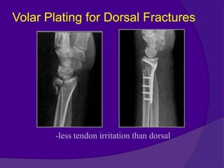 Dr. yt reddy distal radius fractures modified | PPTX