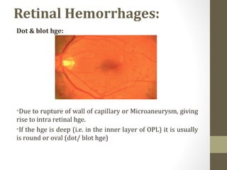 Retinal Hemorrhages:
Dot & blot hge:
•Due to rupture of wall of capillary or Microaneurysm, giving
rise to intra retinal hge.
•If the hge is deep (i.e. in the inner layer of OPL) it is usually
is round or oval (dot/ blot hge)
 