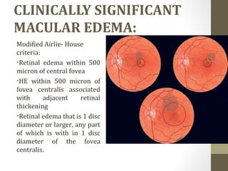 CLINICALLY SIGNIFICANT
MACULAR EDEMA:
Modified Airlie- House
criteria:
•Retinal edema within 500
micron of central fovea
•HE within 500 micron of
fovea centralis associated
with adjacent retinal
thickening
•Retinal edema that is 1 disc
diameter or larger, any part
of which is with in 1 disc
diameter of the fovea
centralis.
 
