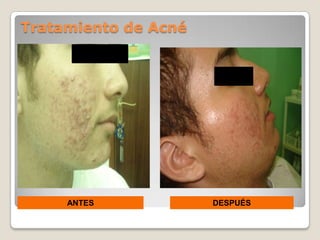 Tratamiento de Acné




     ANTES            DESPUÉS
 
