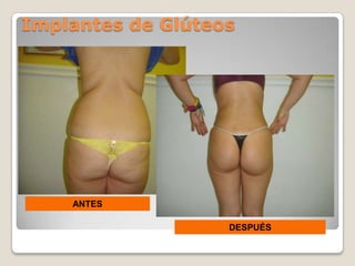 Implantes de Glúteos




    ANTES

                   DESPUÉS
 