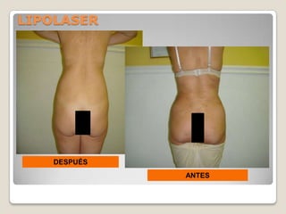 LIPOLASER




    DESPUÉS
              ANTES
 