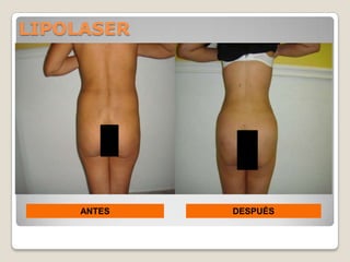 LIPOLASER




    ANTES   DESPUÉS
 