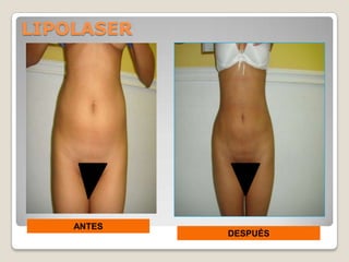 LIPOLASER




    ANTES
            DESPUÉS
 