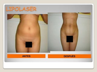 LIPOLASER




    ANTES   DESPUÉS
 