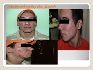 Tratamiento de Acné
 