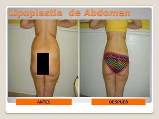 Lipoplastia de Abdomen




     ANTES        DESPUÉS
 