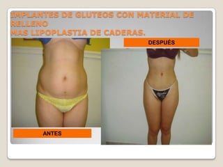 IMPLANTES DE GLUTEOS CON MATERIAL DE
RELLENO
MAS LIPOPLASTIA DE CADERAS.
                           DESPUÉS




      ANTES
 