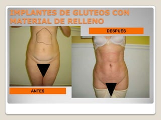 IMPLANTES DE GLUTEOS CON
MATERIAL DE RELLENO
                   DESPUÉS




    ANTES
 