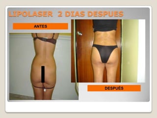 LIPOLASER 2 DIAS DESPUES
     ANTES




                    DESPUÉS
 