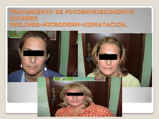 TRATAMIENTO DE FOTOENVEJECIMIENTO
CUTANEO
PEELINGS-MICRODERM-HIDRATACION.
 