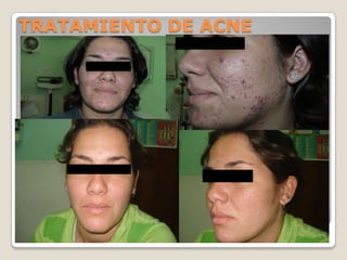 TRATAMIENTO DE ACNE
 