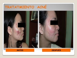 TRATATMIENTO ACNÉ




    ANTES           DESPUÉS
 