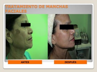 TRATAMIENTO DE MANCHAS
FACIALES




     ANTES          DESPUÉS
 