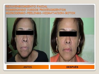 REJUVENECIMIENTO FACIAL
COMBINANDO VARIOS PROCEDIMIENTOS
MICRODERMO-PEELINGS-HIDRATACION-BOTOX




         ANTES                  DESPUÉS
 