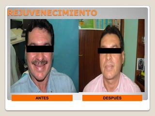 REJUVENECIMIENTO




     ANTES         DESPUÉS
 